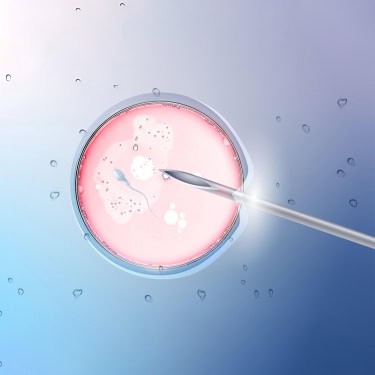 IUI –Intrauterine Insemination or Artificial Insemination (AI)